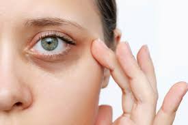 mujer con ojeras moradas