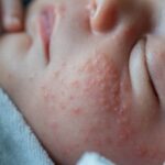alergias en lactantes